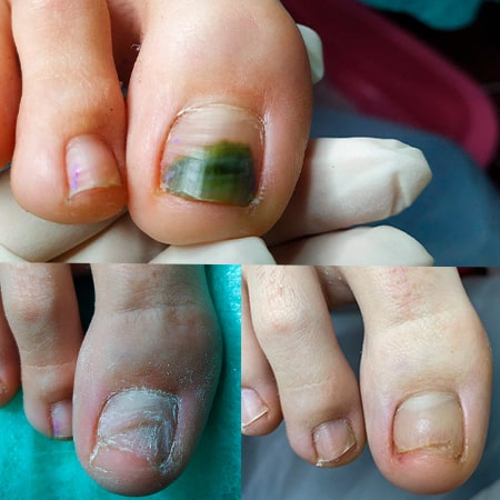 Лікування врослого нігтя. Результат за 4 місяця