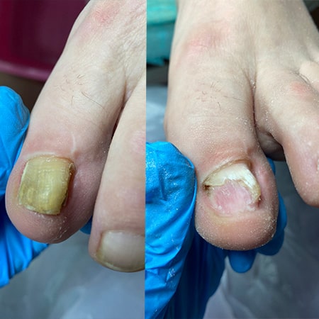 Лікування врослого нігтя. Результат за 2 місяця