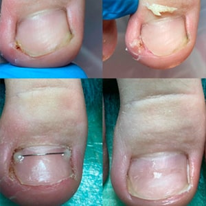 Лікування врослого нігтя. Результат за 4 місяця