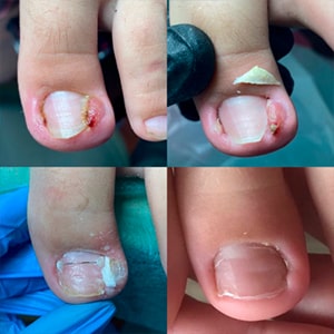 Лікування врослого нігтя. Результат за 2 місяця